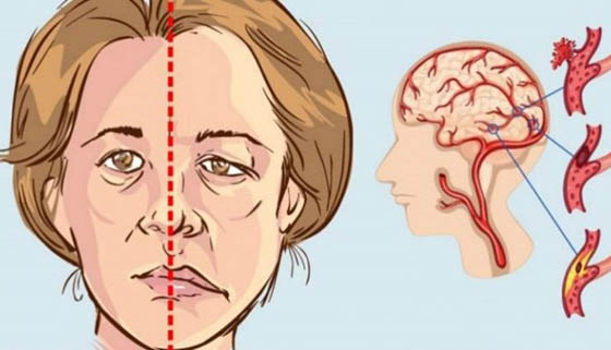 Năm dấu hiệu thể hiện sắp bị tai biến